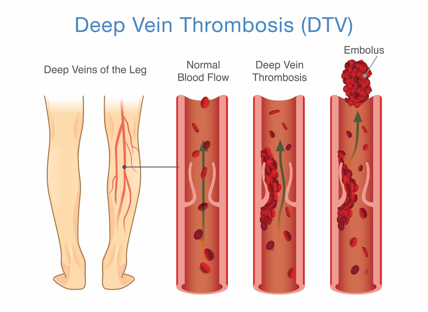 Visual diagram of thrombosis.
