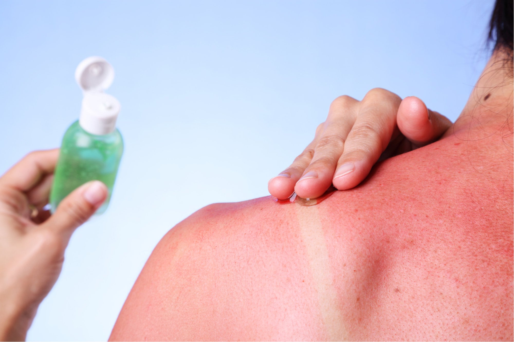 a woman applying ale to a sunburn on her back